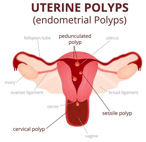 Polip Endometrium